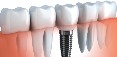 Dental Implants - Costa Rica